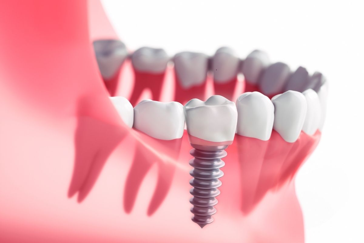 dental implants phoenix