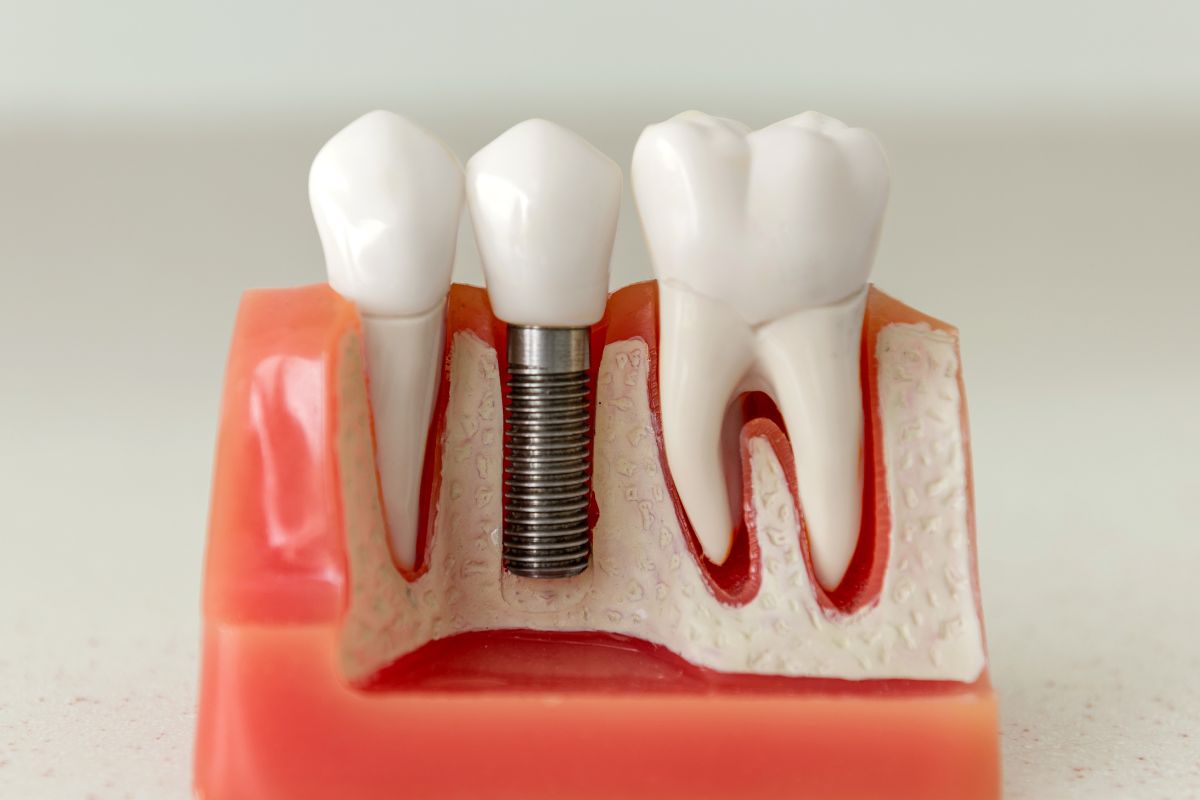 dental implants in phoenix